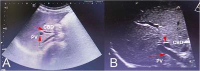 Congenital absence of the gallbladder in a child: a case report